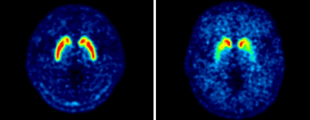 정상인(왼쪽)과 파킨슨병 환자의 도파민 분비를 촬영한 PET-CT 사진. 정상인에 비해 파킨슨병 환자의 도파민 신경세포가 확연히 소실된 것을 확인할 수 있다. 부산백병원 제공