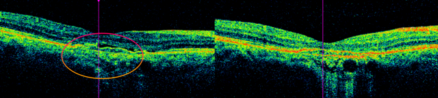 65세 A 씨는 시력이 저하되고 물체가 가끔 찌그러져보이는 증상으로 부산의료원을 찾아 주사 치료를 받았다. 빛간섭단층촬영에서 망막하액(원 안)이 관찰된 모습과 3차례 주사 치료 후 망막하액이 사라진 모습(오른쪽). 부산의료원 제공