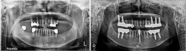 치아가 여러 개 빠진 뒤에도 치과 치료를 두려워해 위아래 부분 틀니를 착용하고 있던 61세 환자의 내비게이션 임플란트 수술 전(왼쪽)과 후 방사선 사진. 노바치과 제공