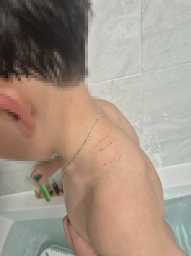 B군 학부모가 말하는 당시 원통에 끼여 목에 생긴 상처. B군 학부모 제공