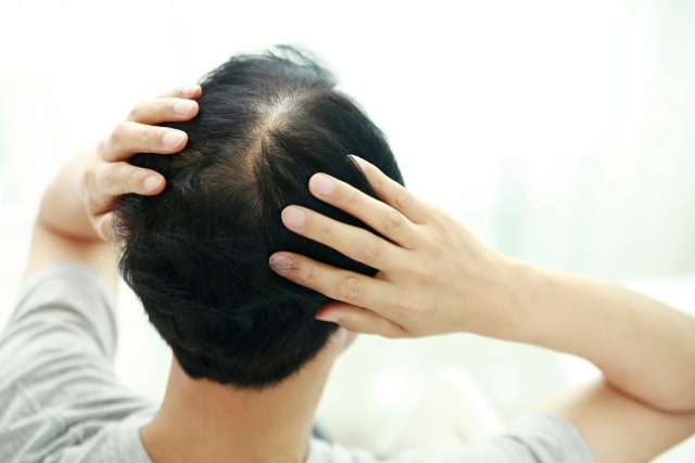 15일 글로벌 시장조사기관 그랜드 뷰 리서치에 따르면 전 세계 탈모 치료 시장은 2030년 160억달러(약 23조원)에 이른다. 치료 방식을 보면 의약품 치료가 98.8%로 기기 치료 등을 제치고 압도적인 비율을 차지한다. 클립아트코리아