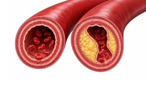 왼쪽은 정상 경동맥, 오른쪽은 플라크로 혈관 내강이 좁아진 경동맥. 동아심혈다하는내과 제공